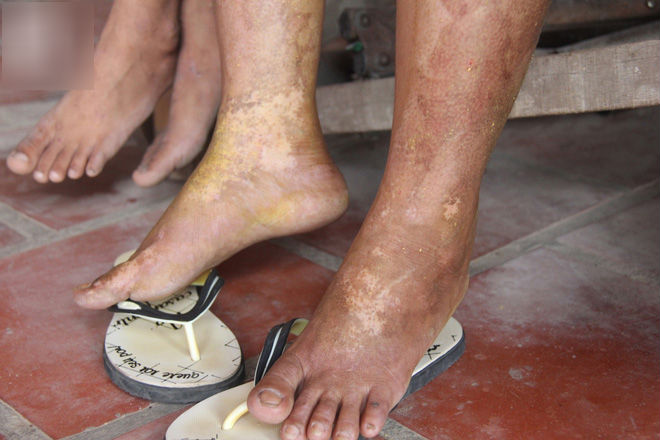 Con rể ghen với bố vợ, phóng hỏa đốt cả nhà khiến bố vợ tử vong, hai mẹ con bị phỏng không có tiền chạy chữa