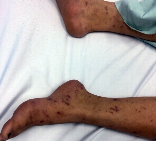 Thiếu nữ 15 tuổi ở Hà Nội bị cách ly do viêm não mô cầu