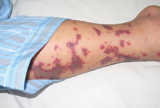 Bệnh 1 người mắc hàng chục người bị cách ly xuất hiện ở Hà Nội đáng sợ thế nào?