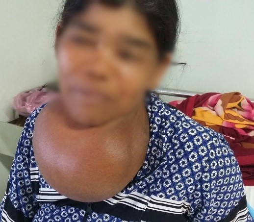 Người phụ nữ mang khối bướu khổng lồ ở cổ suốt 35 năm