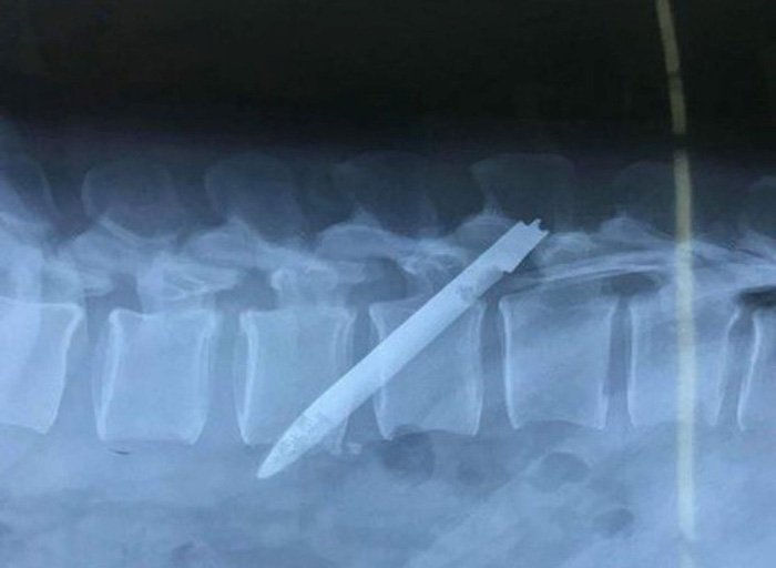 Lưỡi dao 13cm ‘ngủ quên’ ở lưng chiến sĩ công an suốt 11 năm