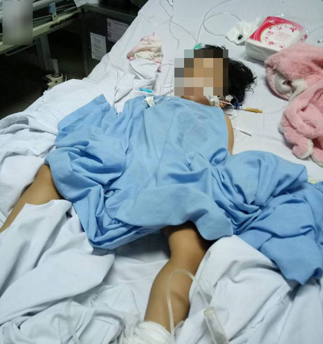 Bé gái 20 tháng tuổi bị rạn hộp sọ, hôn mê sâu, liệt nửa người sau khi đến trường mầm non 3 ngày