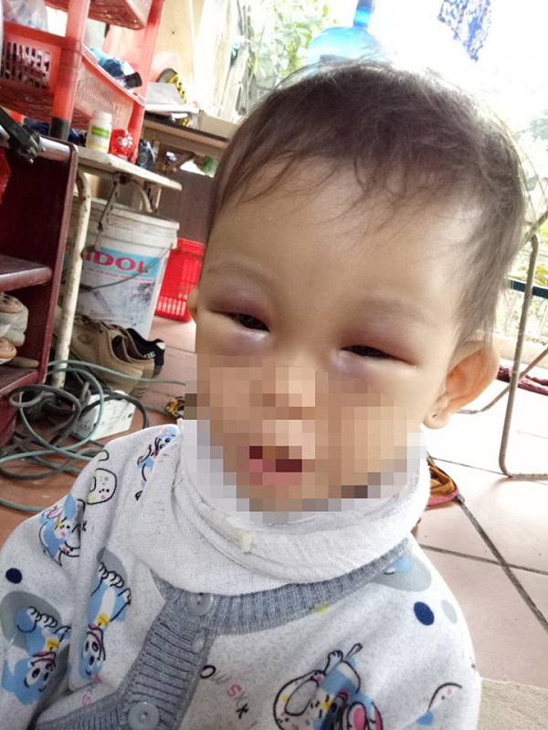 Hà Nội: Bé 14 tháng mắt tím đen, mặt sưng vù bất thường sau buổi học ở trường mầm non
