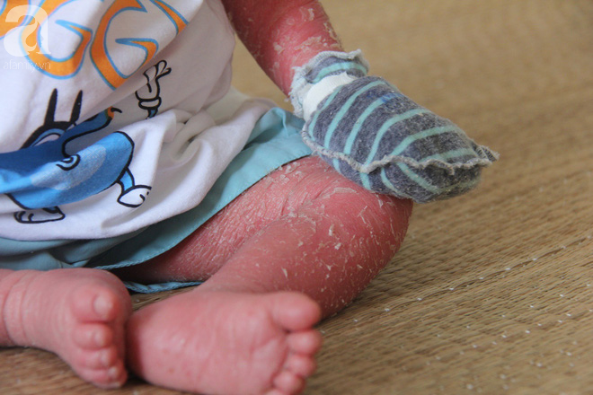 Người đầy vẩy ngứa như da trăn, bé gái 14 tháng tuổi bị bố mẹ bỏ rơi nên không có tiền chữa trị