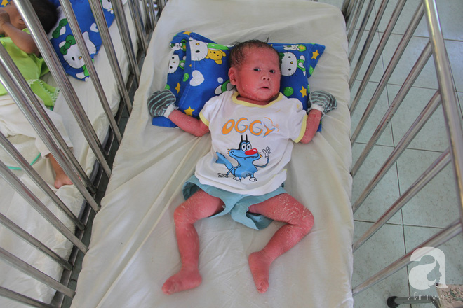 Người đầy vẩy ngứa như da trăn, bé gái 14 tháng tuổi bị bố mẹ bỏ rơi nên không có tiền chữa trị
