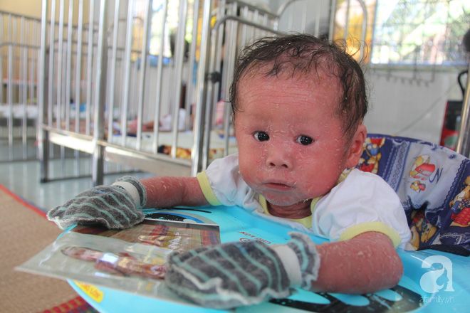 Người đầy vẩy ngứa như da trăn, bé gái 14 tháng tuổi bị bố mẹ bỏ rơi nên không có tiền chữa trị