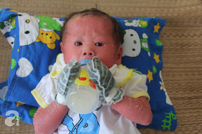 Người đầy vẩy ngứa như da trăn, bé gái 14 tháng tuổi bị bố mẹ bỏ rơi nên không có tiền chữa trị