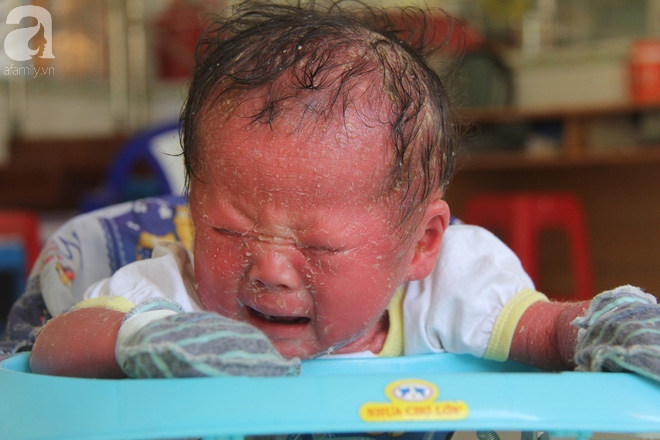Người đầy vẩy ngứa như da trăn, bé gái 14 tháng tuổi bị bố mẹ bỏ rơi nên không có tiền chữa trị