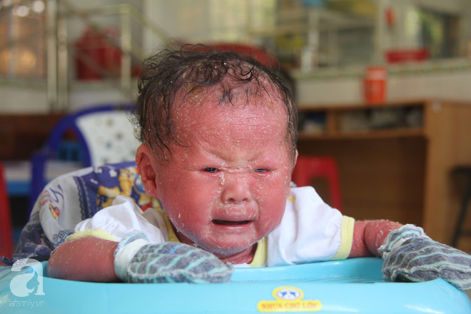 Người đầy vẩy ngứa như da trăn, bé gái 14 tháng tuổi bị bố mẹ bỏ rơi nên không có tiền chữa trị