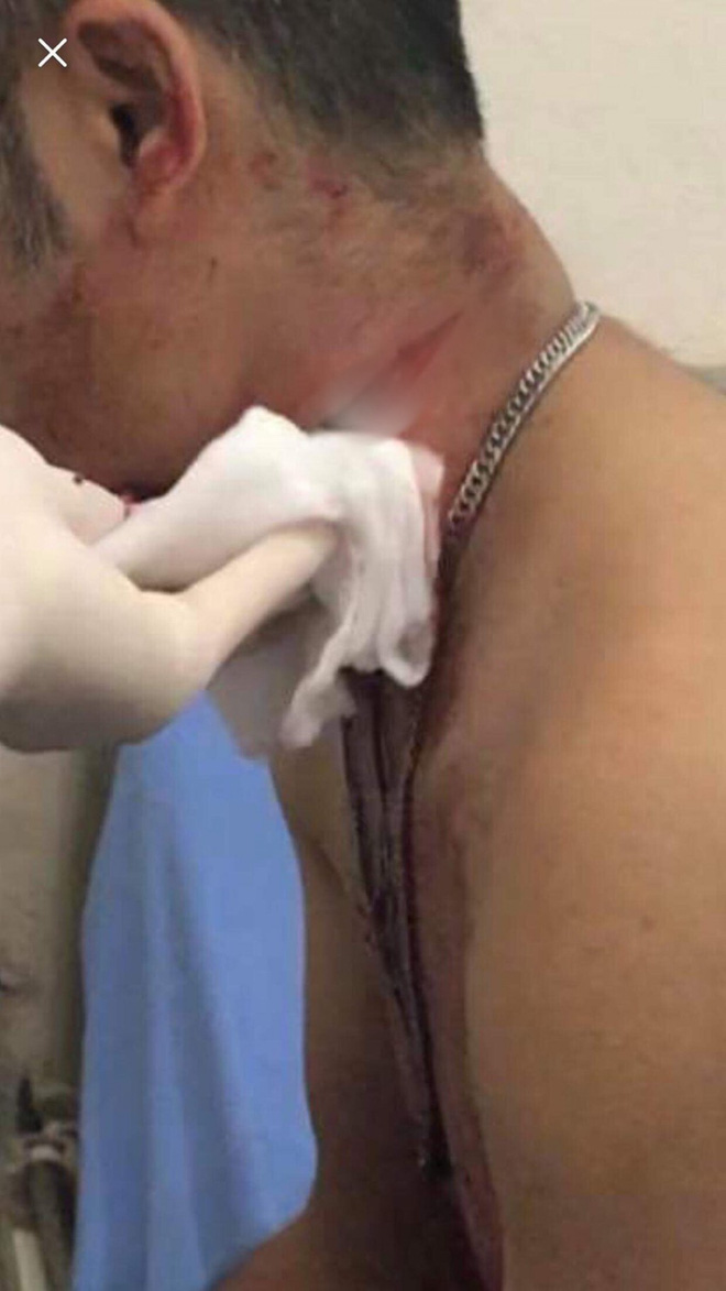 Quảng Ninh: Kinh hoàng 3 công nhân bị nhóm côn đồ xông vào công ty cứa cổ