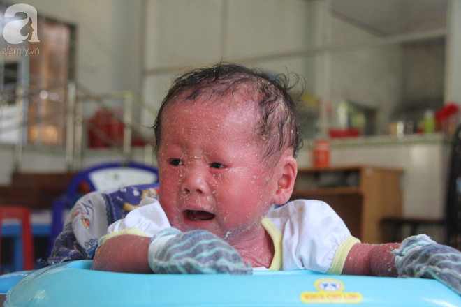 Phép màu kỳ diệu đã đến với bé gái 14 tháng tuổi người đầy vẩy ngứa như da trăn