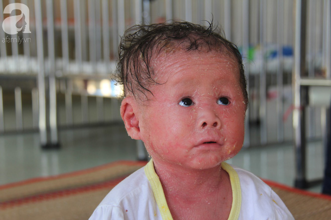 Phép màu kỳ diệu đã đến với bé gái 14 tháng tuổi người đầy vẩy ngứa như da trăn