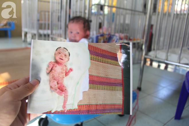 Phép màu kỳ diệu đã đến với bé gái 14 tháng tuổi người đầy vẩy ngứa như da trăn