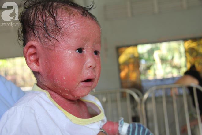 Phép màu kỳ diệu đã đến với bé gái 14 tháng tuổi người đầy vẩy ngứa như da trăn