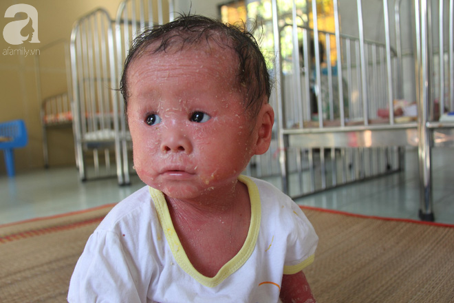 Phép màu kỳ diệu đã đến với bé gái 14 tháng tuổi người đầy vẩy ngứa như da trăn