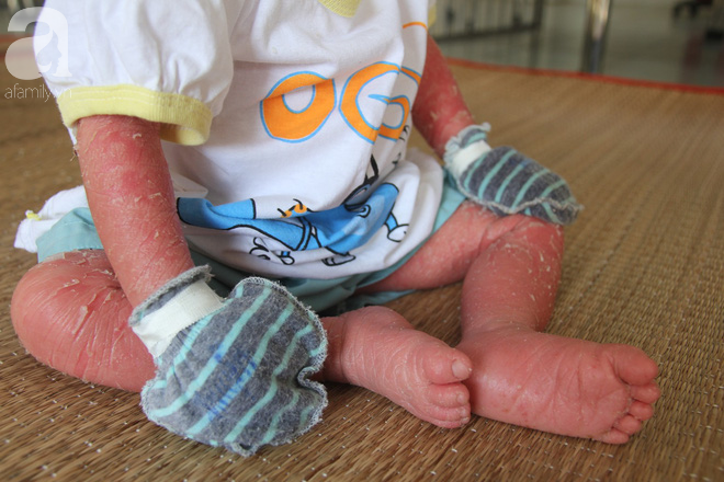 Phép màu kỳ diệu đã đến với bé gái 14 tháng tuổi người đầy vẩy ngứa như da trăn