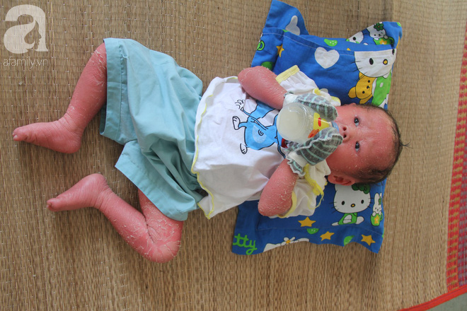 Phép màu kỳ diệu đã đến với bé gái 14 tháng tuổi người đầy vẩy ngứa như da trăn