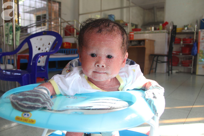 Phép màu kỳ diệu đã đến với bé gái 14 tháng tuổi người đầy vẩy ngứa như da trăn