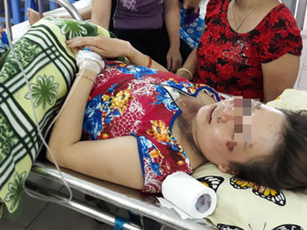 Sét đánh đứt dây chuyền vàng, người đeo cháy cổ