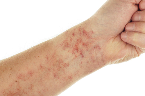 12 dấu hiệu cảnh báo bệnh lupus ban đỏ