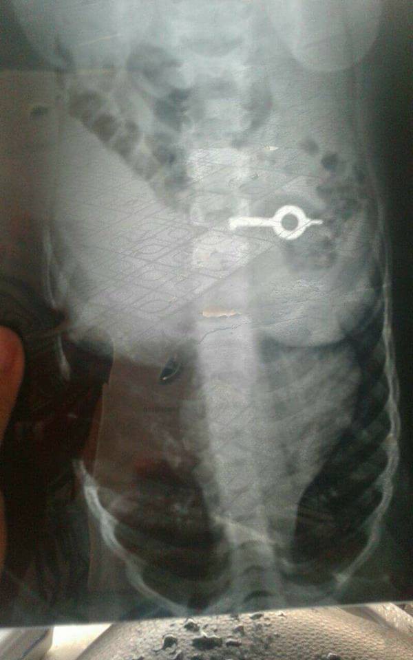 Mẹ bàng hoàng phát hiện con 5 tuổi nuốt trọn chiếc chìa khóa vào bụng