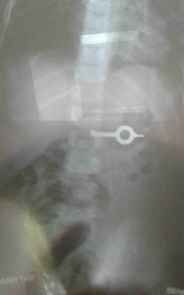 Mẹ bàng hoàng phát hiện con 5 tuổi nuốt trọn chiếc chìa khóa vào bụng