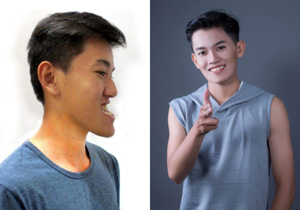 Bà nội đồng hành cùng cháu trai để phẫu thuật thẩm mỹ gương mặt