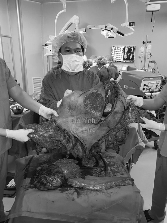 Bác sĩ choáng với khối u nặng 45 kg trên người nam thanh niên