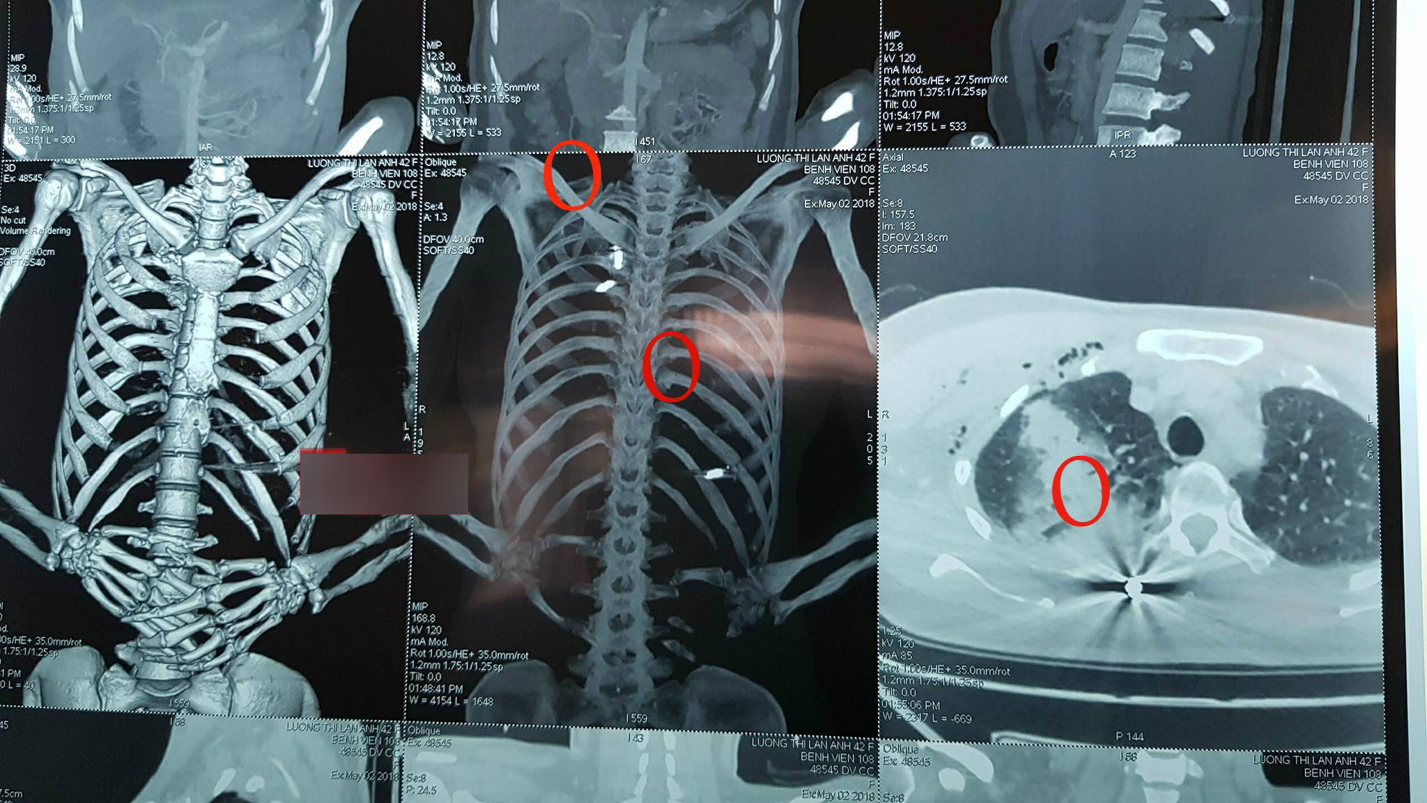 Thông tin mới nhất về sức khỏe nữ Giám đốc bị bắn ở Bắc Giang