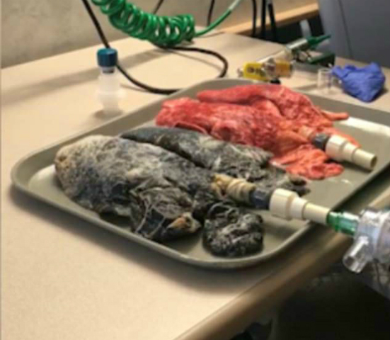 Khác biệt giữa phổi của người khỏe mạnh và người hút thuốc 20 năm