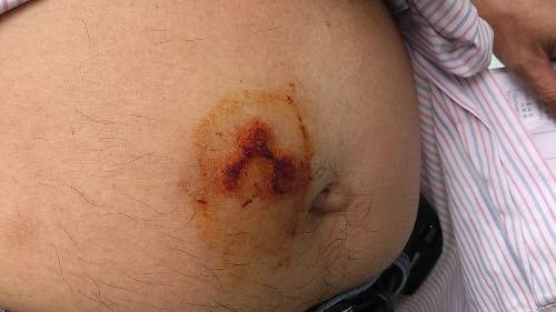 Cẩn trọng với quái vật đẻ trứng, hoành hành trong mùa hè gây bệnh viêm da, mù mắt, dễ nhầm lẫn với bệnh zona