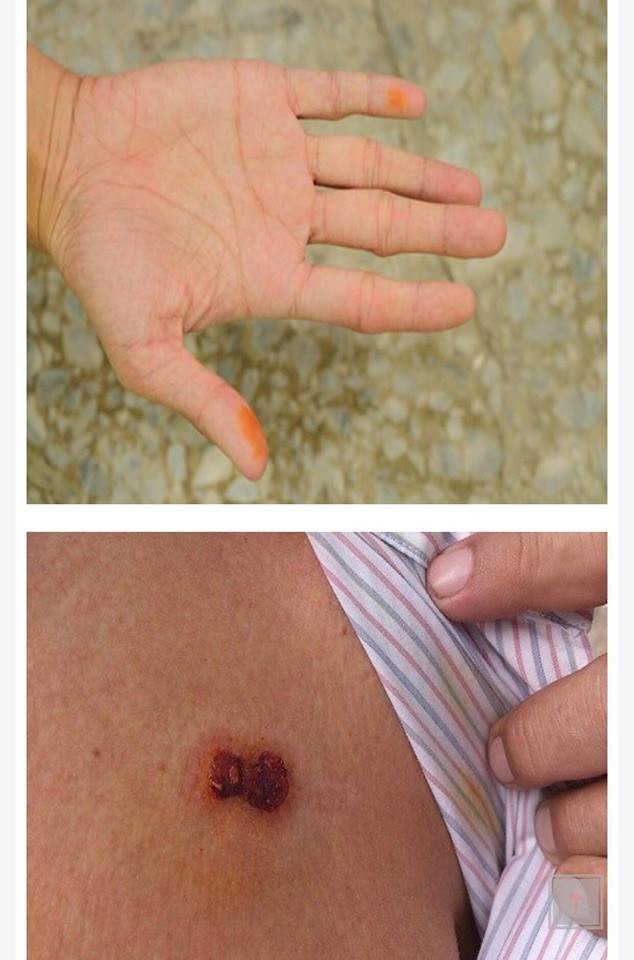 Cẩn trọng với quái vật đẻ trứng, hoành hành trong mùa hè gây bệnh viêm da, mù mắt, dễ nhầm lẫn với bệnh zona