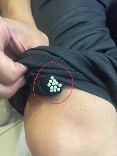 Cẩn trọng với quái vật đẻ trứng, hoành hành trong mùa hè gây bệnh viêm da, mù mắt, dễ nhầm lẫn với bệnh zona