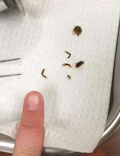 Phát hiện gián bò vào tai, người phụ nữ lập tức đến bác sĩ lấy ra, 9 ngày sau cô rùng mình khi biết mọi thứ vẫn chưa kết thúc