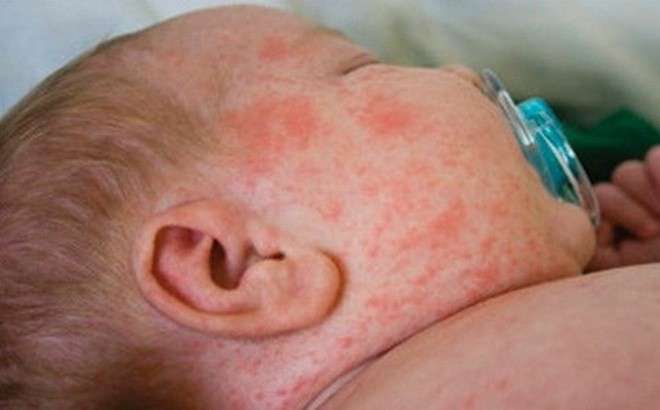 Những biến chứng nguy hiểm của sốt virus