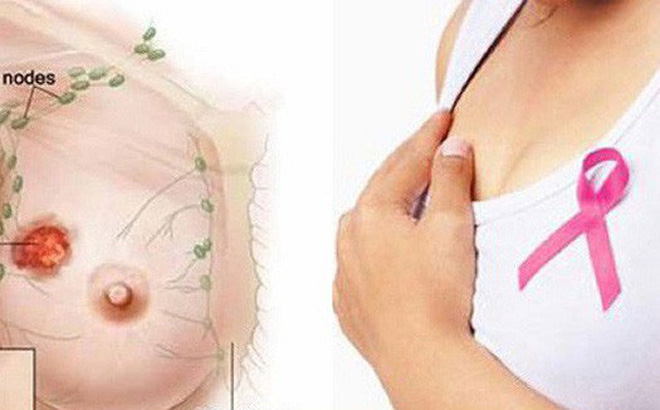 Dấu hiệu cảnh báo ung thư vú, mọi chị em nên biết