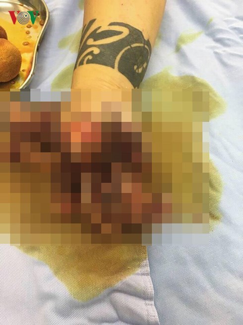 Cầm lựu đạn thật tưởng đồ giả, người phụ nữ bị nổ nát tay