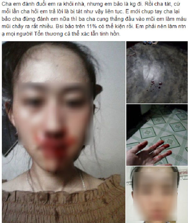 Bị đánh gãy xương mũi, con gái đau đớn viết tâm thư tố bị chính cha ruột bạo hành Bị đánh gãy xương mũi, con gái đau đớn viết tâm thư tố bị chính cha ruột bạo hành