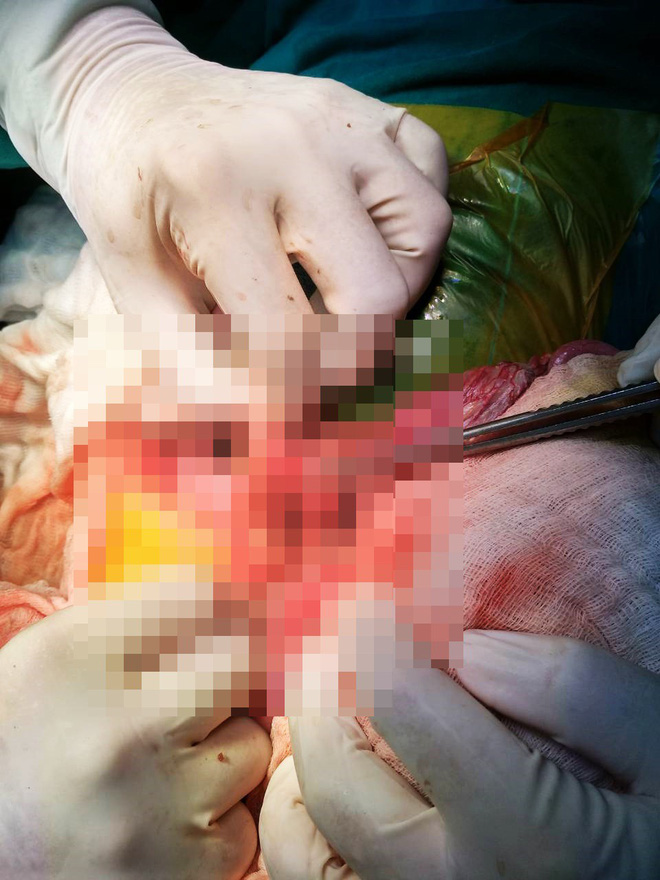 Phụ huynh quên tắt máy, bé trai 2 tuổi vặn ga xe máy đè thủng ruột bạn cùng lớp