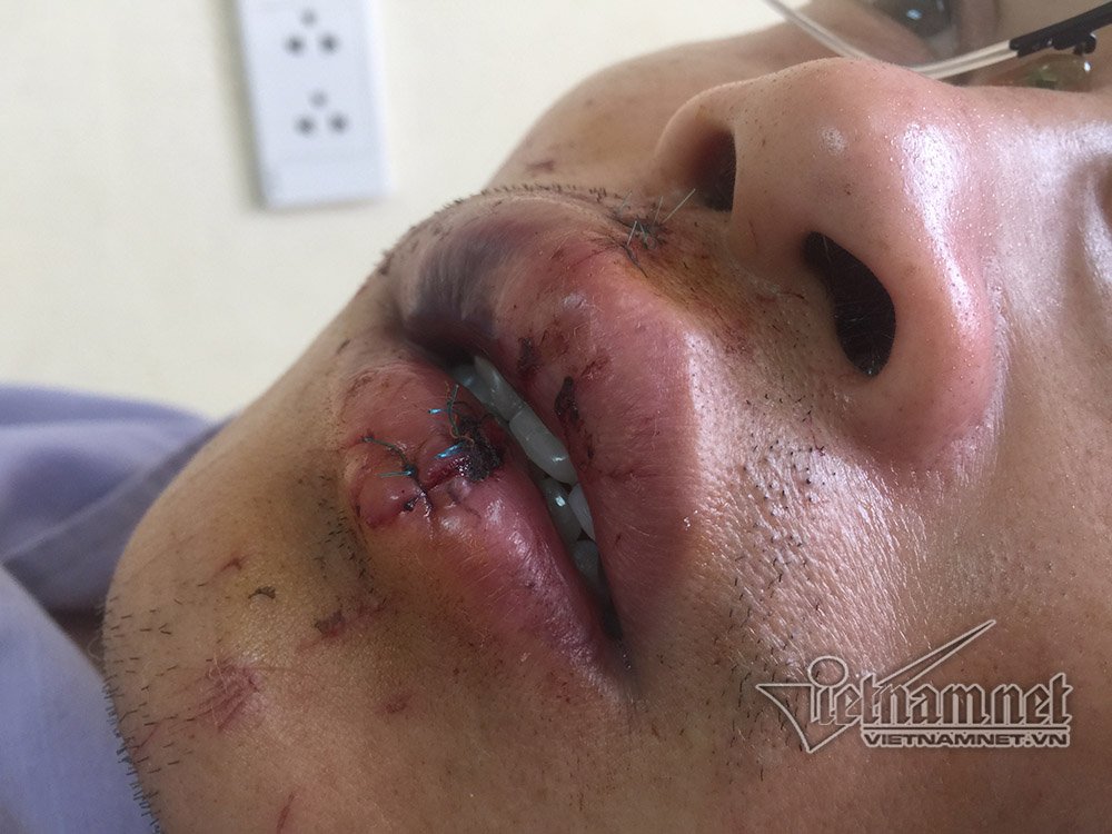 Lý do không ngờ nhân viên cây xăng bị đánh tóe máu mồm