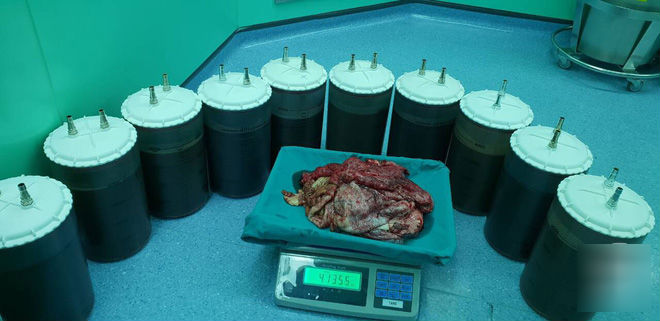 6 giờ ròng rã cứu mạng người phụ nữ mang khối u buồng trứng lớn nhất Việt Nam