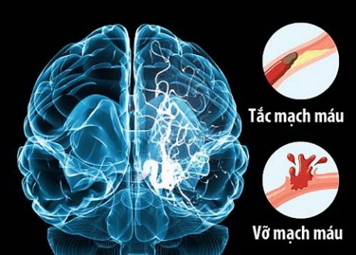Tai biến mạch máu não hay gặp trong mùa hè, vì sao?