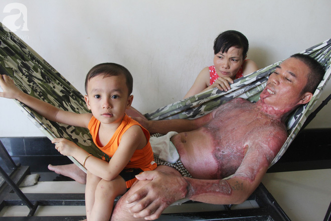 Bị điện giật cháy người không có tiền chạy chữa, bố xót xa nhìn con trai 4 tuổi không nhận ra mình