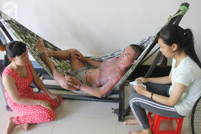 Bị điện giật cháy người không có tiền chạy chữa, bố xót xa nhìn con trai 4 tuổi không nhận ra mình