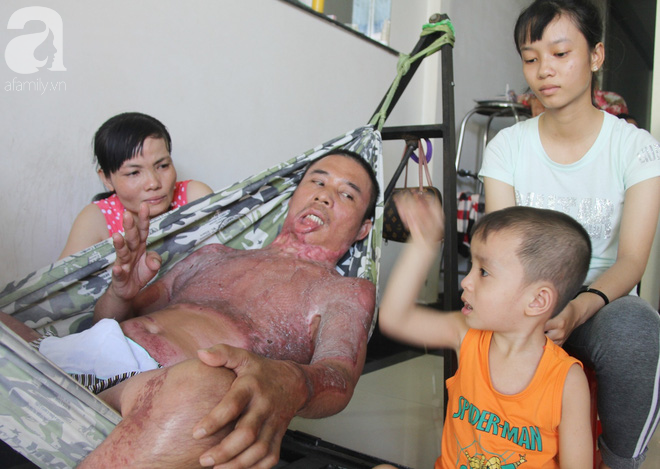 Bị điện giật cháy người không có tiền chạy chữa, bố xót xa nhìn con trai 4 tuổi không nhận ra mình