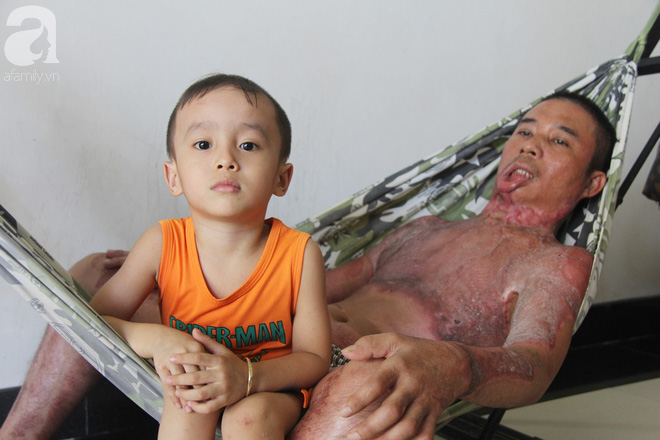 Bị điện giật cháy người không có tiền chạy chữa, bố xót xa nhìn con trai 4 tuổi không nhận ra mình
