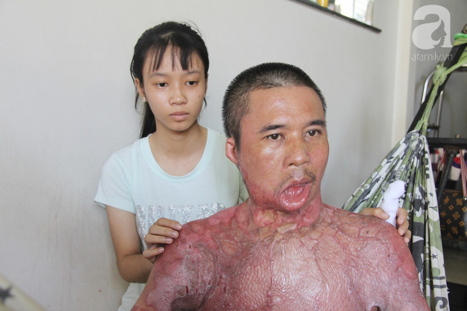 Bị điện giật cháy người không có tiền chạy chữa, bố xót xa nhìn con trai 4 tuổi không nhận ra mình