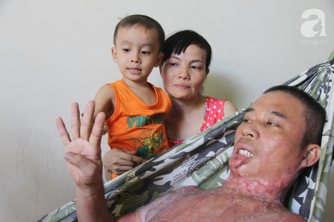 Bị điện giật cháy người không có tiền chạy chữa, bố xót xa nhìn con trai 4 tuổi không nhận ra mình