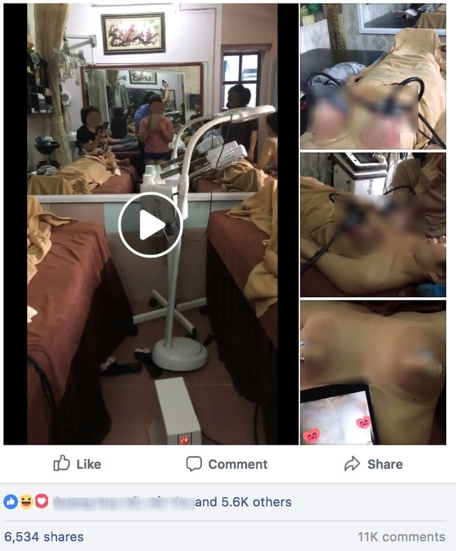 Nâng ngực bằng máy hút chân không: Trò lừa bịp của các cơ sở làm đẹp