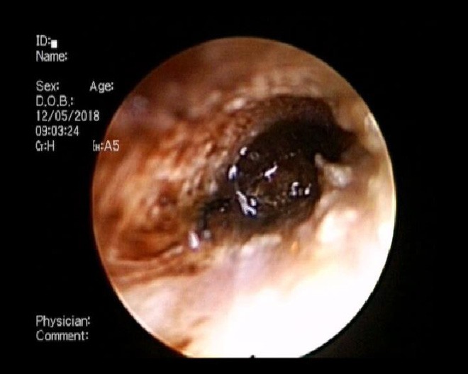TP.HCM: Bé trai 9 tuổi đang ngủ bị vật thể lạ chui vào tai suýt thủng màng nhĩ